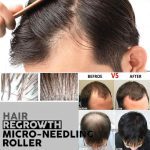 درما رولر NEEDLES 540 ماساژ زیبایی صورت تیتانیومی ۵۴۰ میکرو سوزن - تصویر 7
